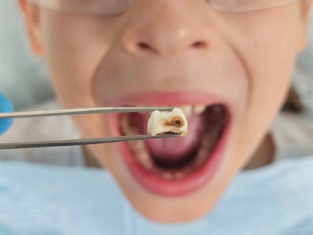 Best Knocked-Out Tooth (Avulsed Tooth) Treatment in Maud, TX